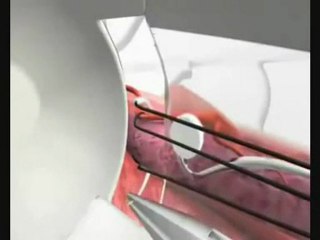 Hémorroidectomie-LigaturVersion en arabe-Dr AMINE