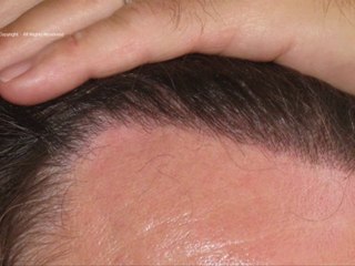 FUT_3507_Ufs_By_MEDIKEMOS_HAIR_TRANSPLANTATION_FR