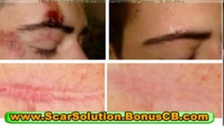 treatments for acne scars - natural acne scar removal - how to remove pimple scars