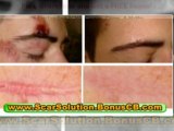 treatments for acne scars - natural acne scar removal - how to remove pimple scars