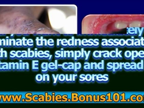 treatment of scabies - scabies home treatment - treating scabies