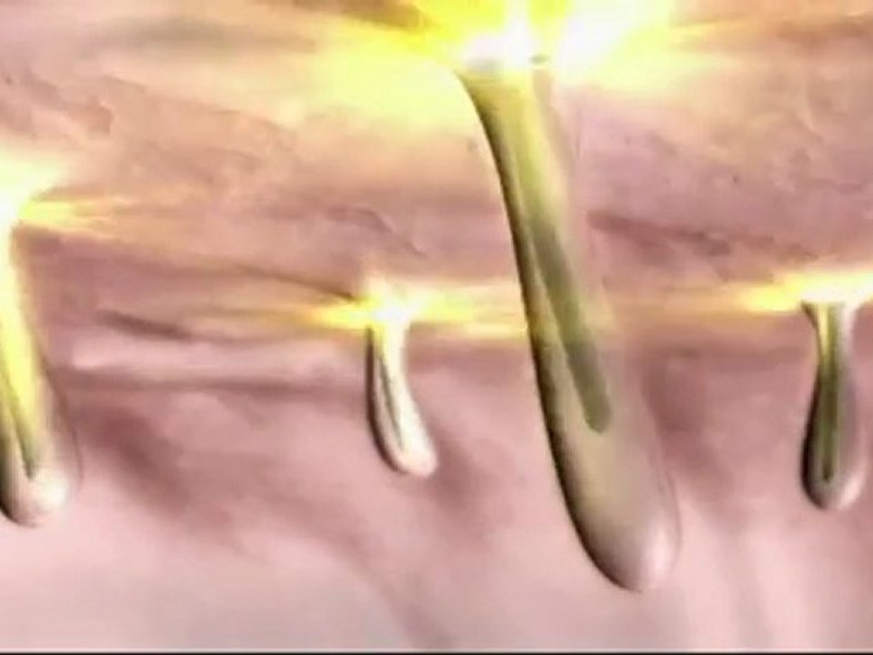 Laser Hair Removal Results by VISS Beauty