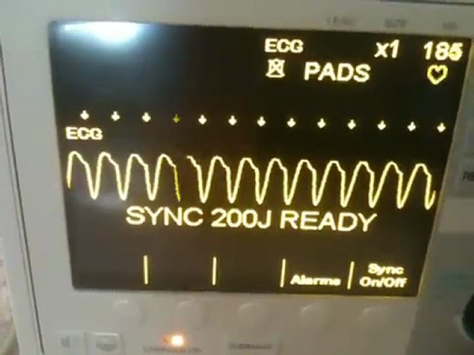 Ventricular Tachycardia cardioverted to Normal Sinus Rhythm per 2010 ACLS Guidelines