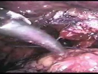 Mete Kilciler - LRP Interreptud Anastamoz 6