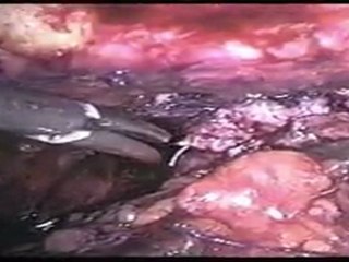 Mete Kilciler - LRP Interreptud Anastamoz 7