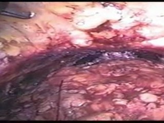 Mete Kilciler - LRP Interreptud Anastamoz Video 8