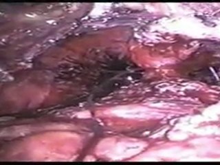 Mete Kilciler - LRP Interreptud Anastamoz Video 2