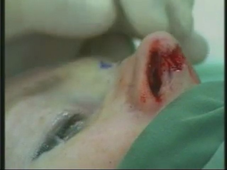 Nasal Arch Reconstruction using MEDPOR Nasal Shell Implant