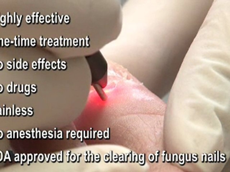 Laser - Fungal Toenails - Podiatrist in Hudson Valley, Ulster, Orange and Dutchess County, NY