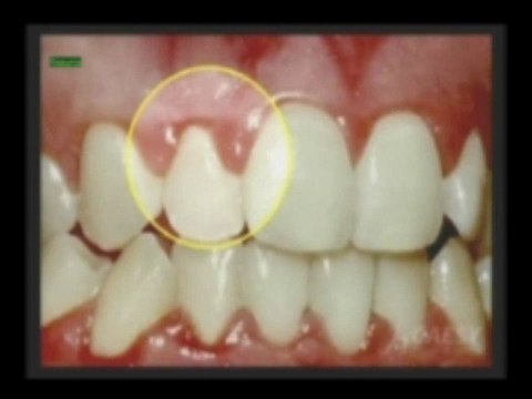 What is Periodontal Disease? by Kamran Sahabi Dentist Glendale, CA