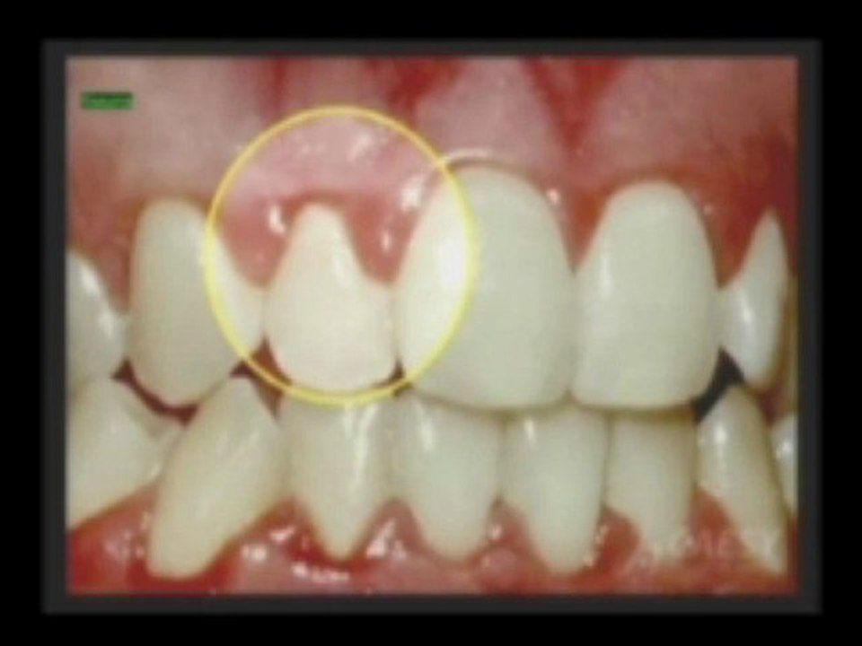 What is Periodontal Disease? by Kamran Sahabi Dentist Glendale, CA