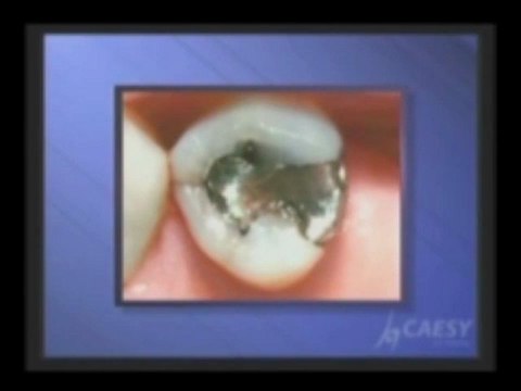 What is a Composite Dental Filling? by Kamran Sahabi Dentist Glendale, CA