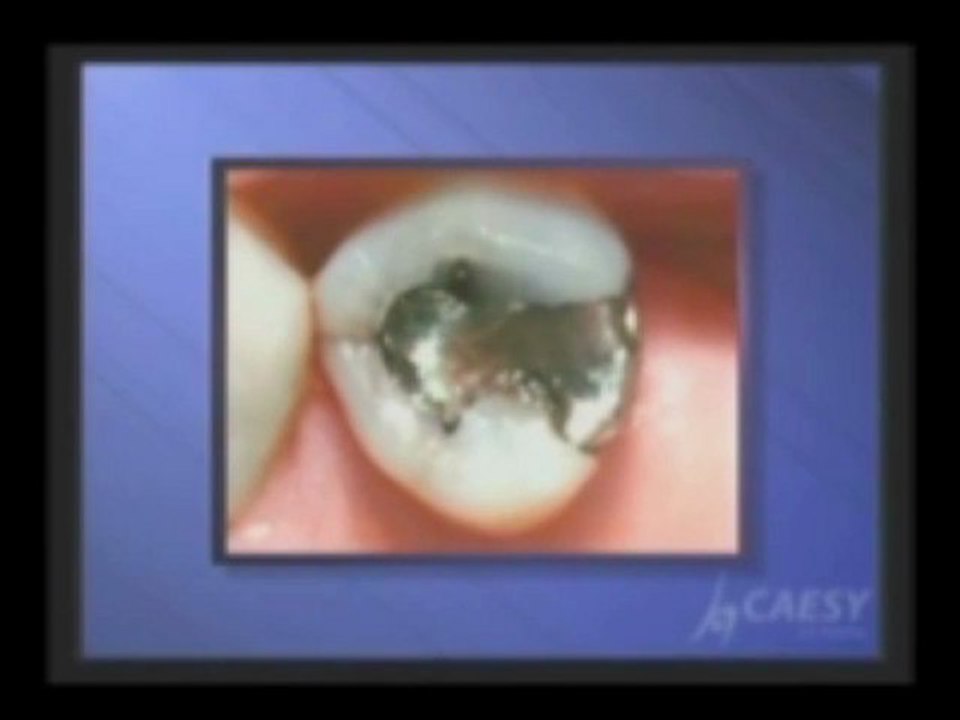 What is a Composite Dental Filling? by Kamran Sahabi Dentist Glendale, CA