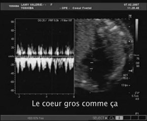 Emilie première écho