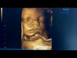 3D ultrasound scanning Alex 30 weeks