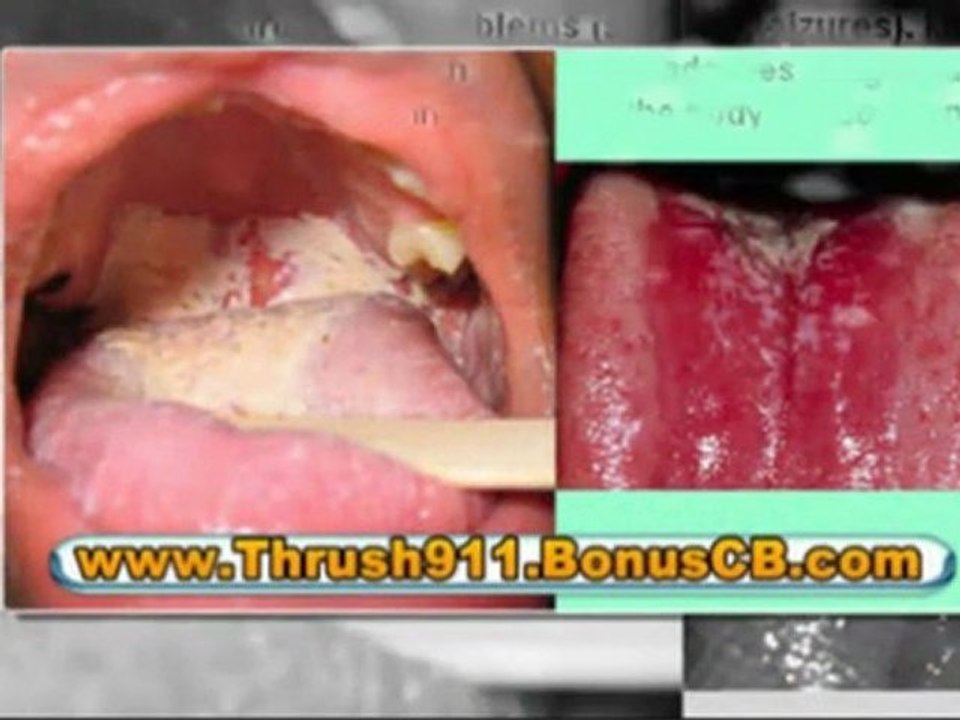 thrush treatment natural - natural remedies for thrush
