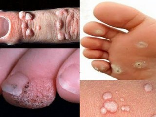 Wie ich endlich meine Warzen wegbekommen habe