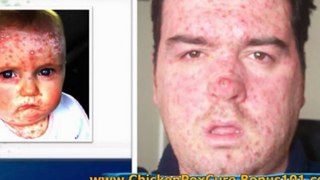 chickenpox in adults - chicken pox treatment - adult chicken pox