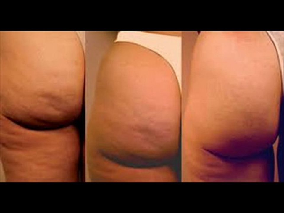como eliminar la celulitis