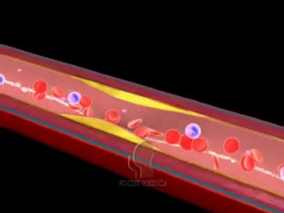 Myocardial Infarction