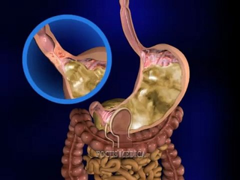 Gastro-Oesophaegal Reflux Disease (GORD)