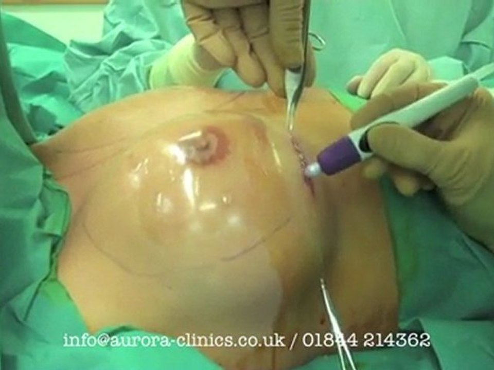 Breast Enlargement with Implant positioned in front of the muscle