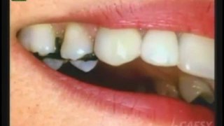The Deficient's of Silver Dental Fillings by Kamran Sahabi Dentist Glendale, CA