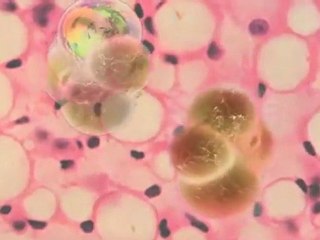 Diabetes and Obesity