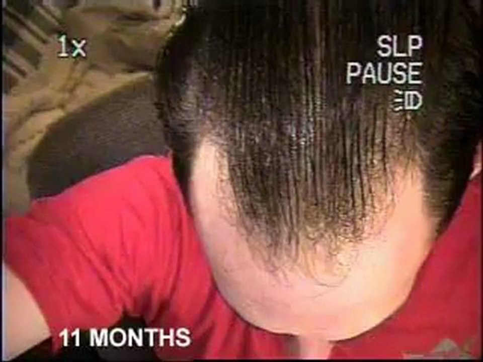 Buy Finasteride online, cheap Finpecia, free prescription.