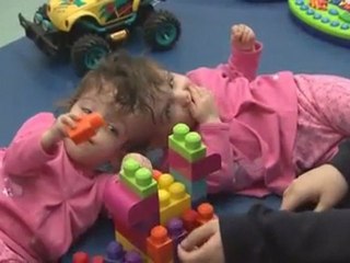 TWINS WHO SHARE A BRAIN