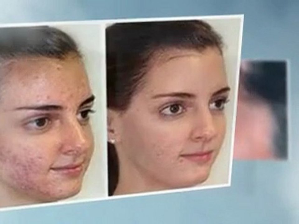 Remove Eczema Forever