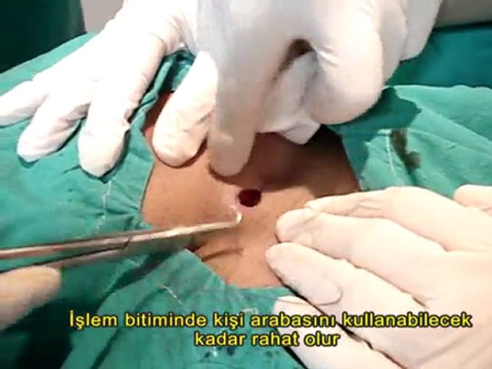 Kıl Dönmesi Ameliyatı Ameliyat Yapılışı