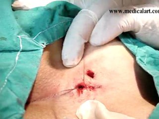 Pilonidal Sinüs Ameliyatı www.pilonidalsinus.gen.tr