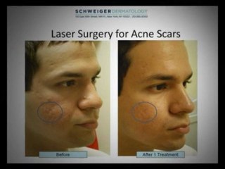 Acne Scar Laser Surgery NYC