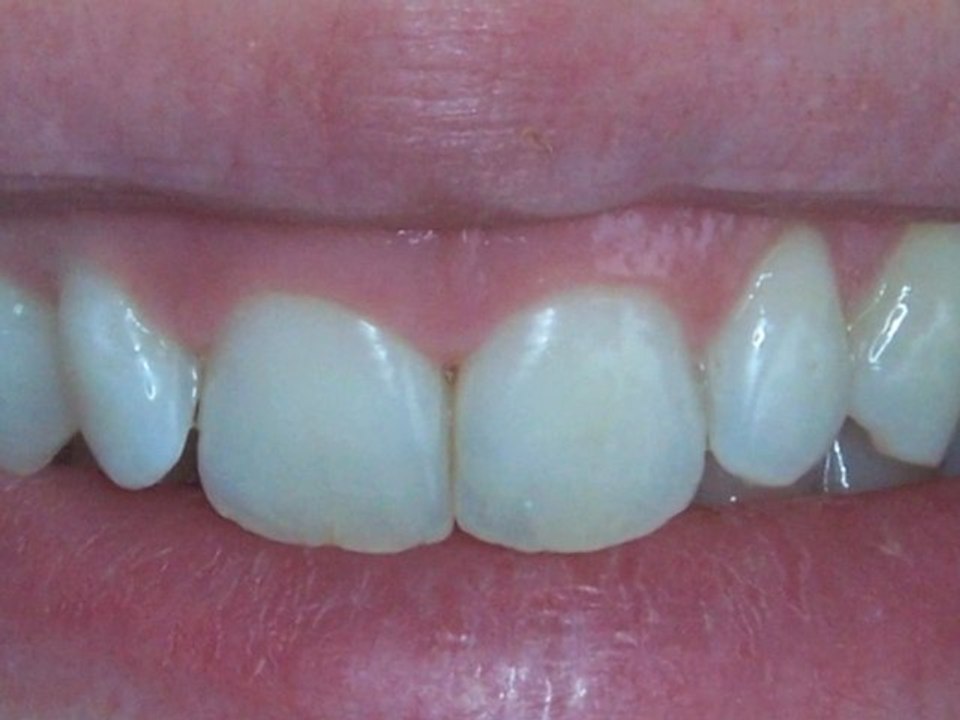 Sourire gingival traité avec des facettes en céramique collée en 2 séances.
