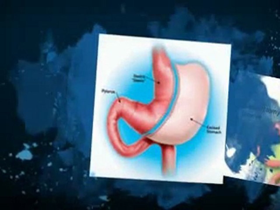 Gastric Sleeve Costs