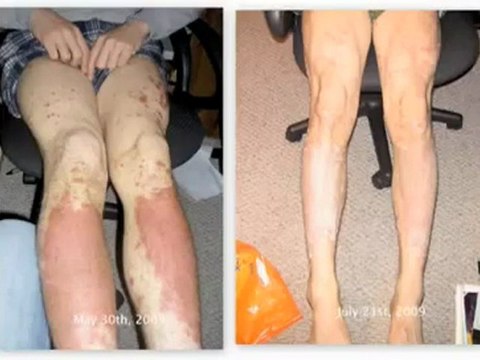 Dermasis, Psoriasis Cure,psoriasis treatment, psoriasis skin, scalp psoriasis, psoriasis.