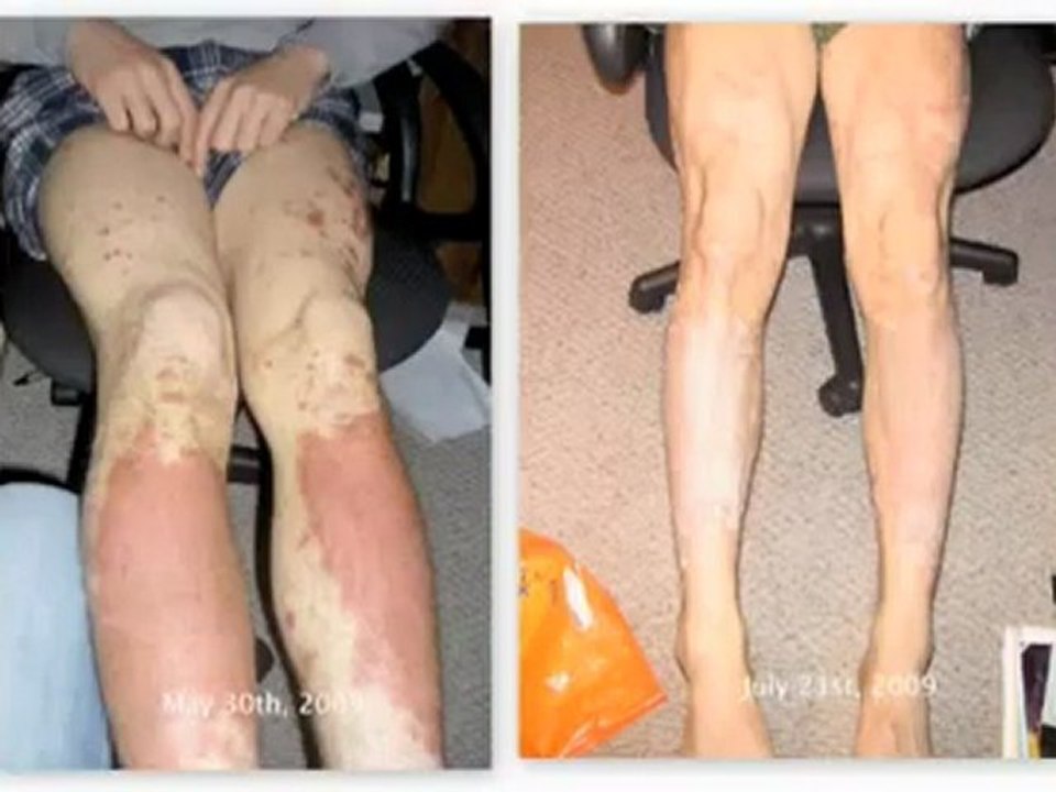 Dermasis, Psoriasis Cure,psoriasis treatment, psoriasis skin, scalp psoriasis, psoriasis.