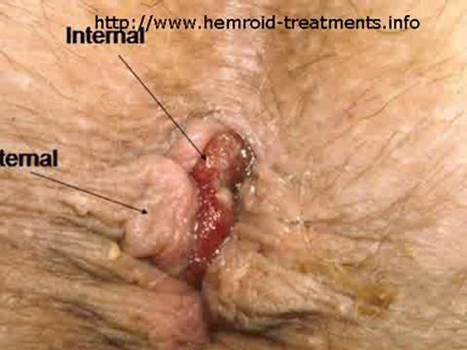 Cure Your Hemorrhoids