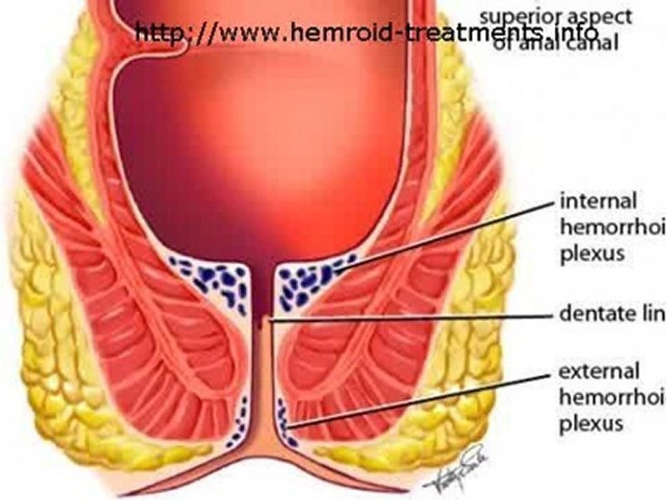 How Can You Get Rid Of Hemorrhoids