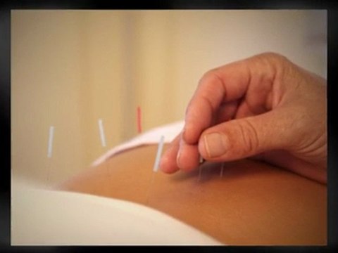 Acupuncture for Menopause Relief