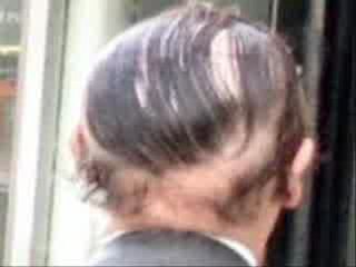 Hair Loss Treatment For Men