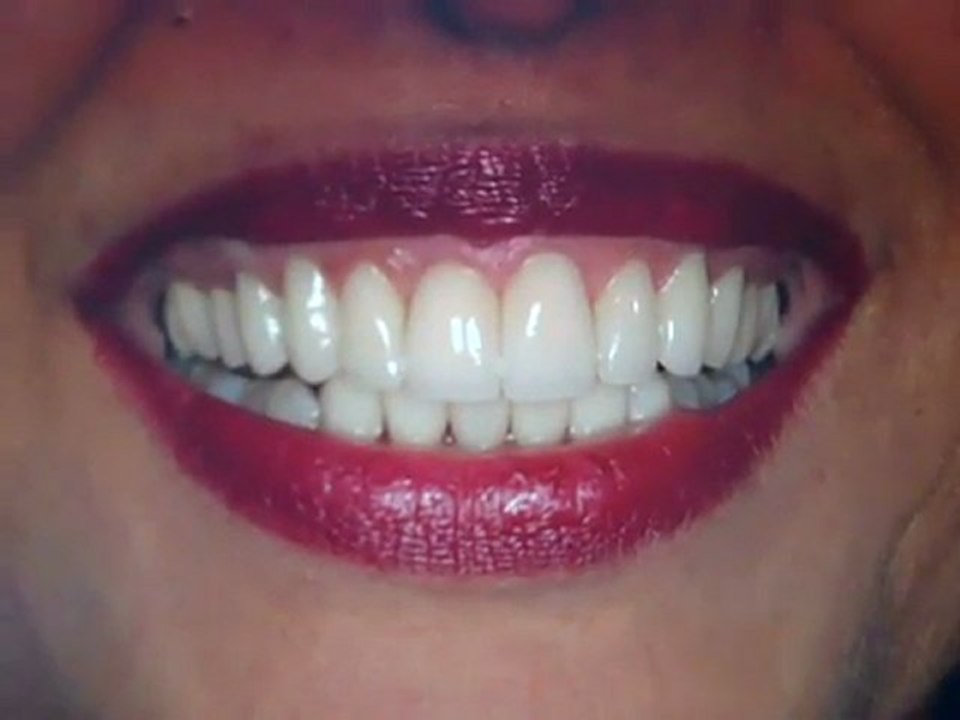 Austin Porcelain veneers for crooked teeth and teeth straightening