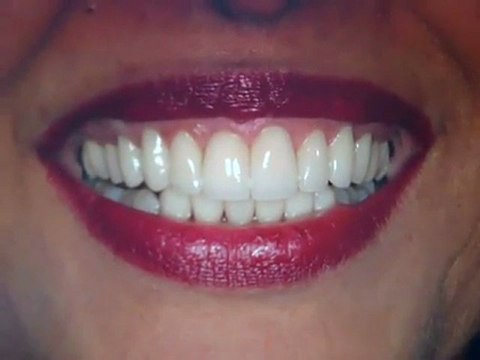 Austin Porcelain veneers for crooked teeth and teeth straightening