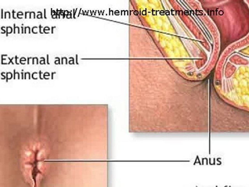 Info And Cure For Hemorrhoids