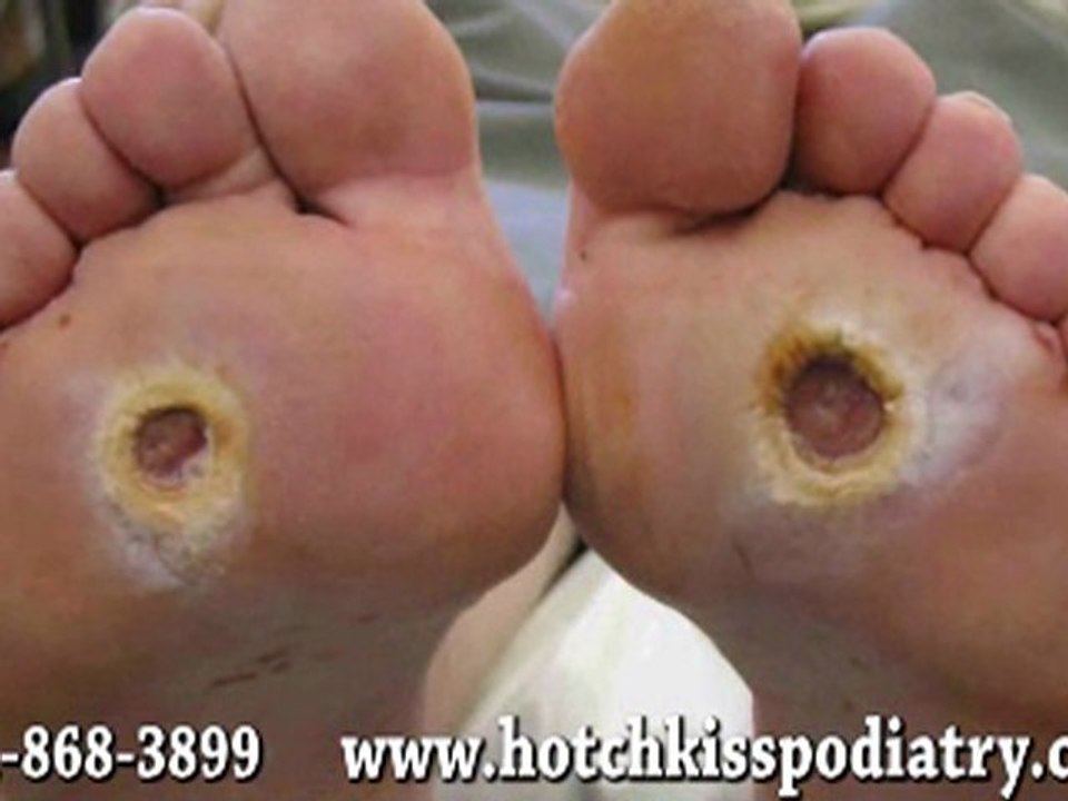 Diabetic Foot Care - Clinton and Waldorf, MD Podiatrist