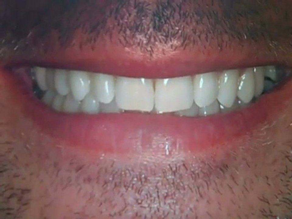 Teeth Straightening Invisalign Austin Tx- Lakeway Clear Braces