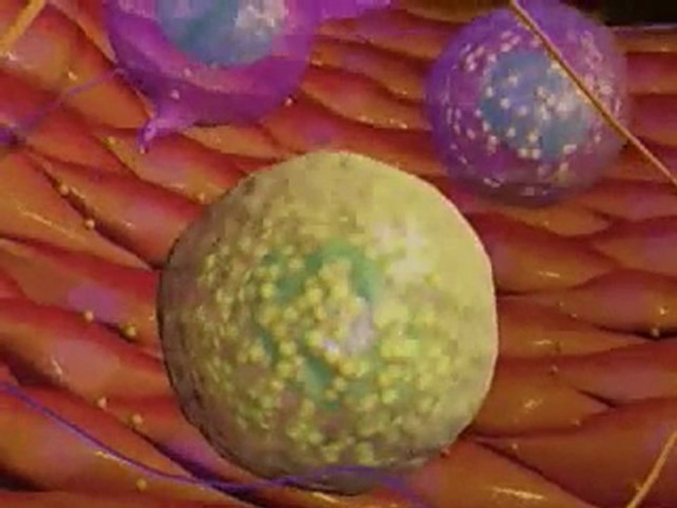 Understanding atherosclerosis