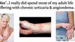 chronic idiopathic urticaria - urticaria causes - dermatographic urticaria