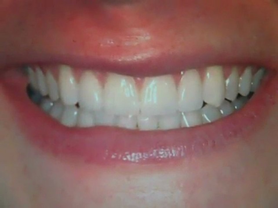Front teeth Gaps fixed - Veneers Austin, Tx- Lakeway